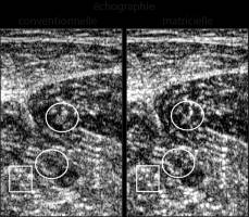 L'imagerie matricielle : une innovation pour améliorer la résolution des échographies
